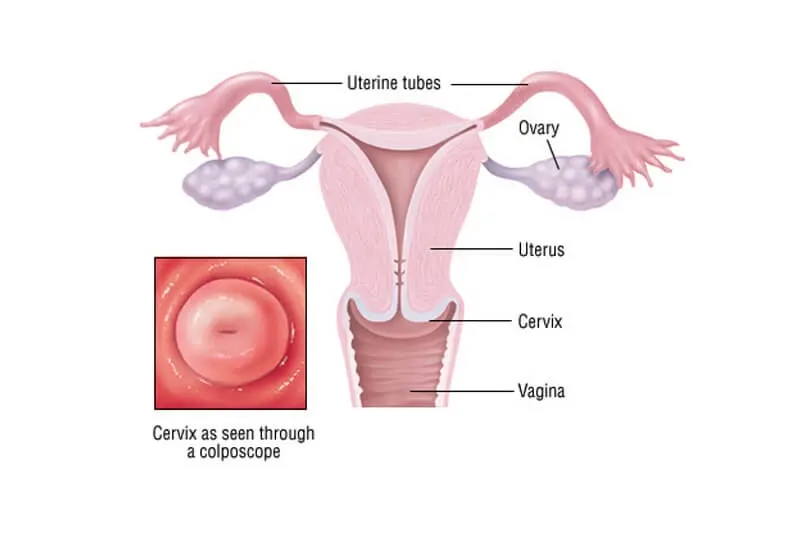 Cervical Cancer Diagram